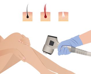 Dióda lézeres szőrtelenítés Budapest városában dióda lézeres szőrtelenítés Budapest