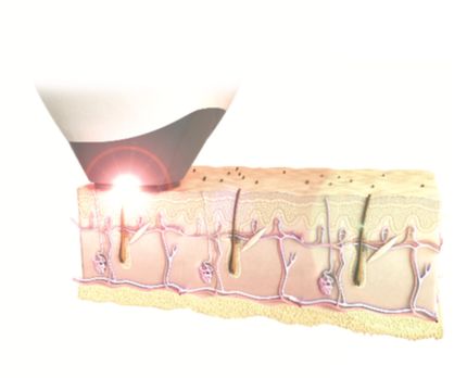 lézeres szőrtelenítés